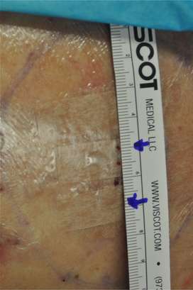 Minimal Incision and Power-assisted Liposuction Removal of Lipomas