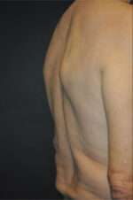 Minimal Incision and Power-assisted Liposuction Removal of Lipomas