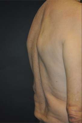Minimal Incision and Power-assisted Liposuction Removal of Lipomas