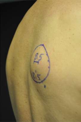 Minimal Incision and Power-assisted Liposuction Removal of Lipomas