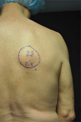 Minimal Incision and Power-assisted Liposuction Removal of Lipomas