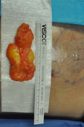 Minimal Incision and Power-assisted Liposuction Removal of Lipomas