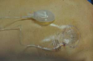 Minimal Incision and Power-assisted Liposuction Removal of Lipomas