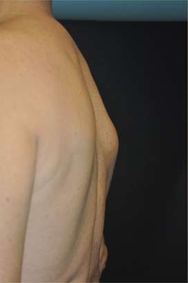 Minimal Incision and Power-assisted Liposuction Removal of Lipomas