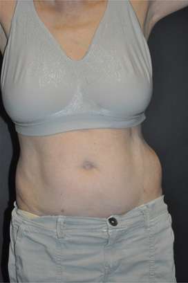 Minimal Incision and Power-assisted Liposuction Removal of Lipomas