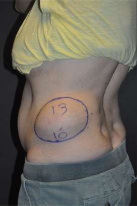 Minimal Incision and Power-assisted Liposuction Removal of Lipomas