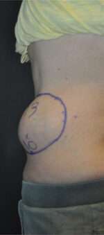 Minimal Incision and Power-assisted Liposuction Removal of Lipomas