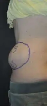 Minimal Incision and Power-assisted Liposuction Removal of Lipomas