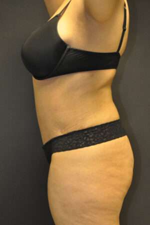Abdominoplasty