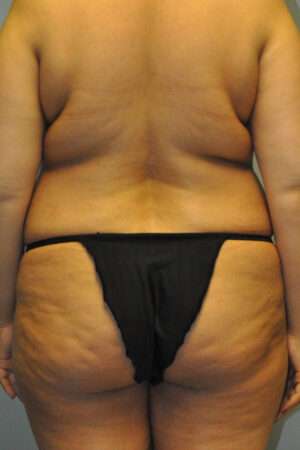 Abdominoplasty