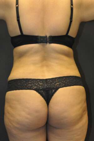Abdominoplasty
