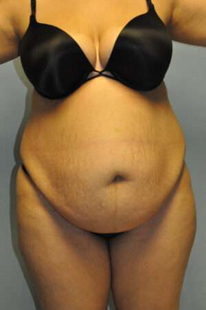 Abdominoplasty
