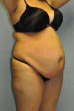 Abdominoplasty
