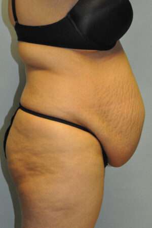 Abdominoplasty