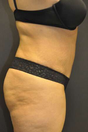 Abdominoplasty
