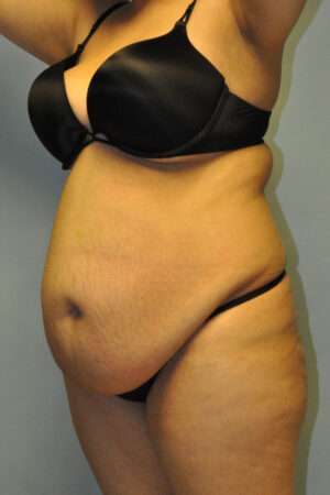 Abdominoplasty