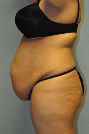 Abdominoplasty