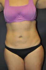 Abdominoplasty