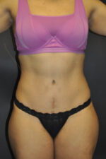 Abdominoplasty