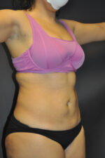 Abdominoplasty