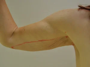 Body Contouring after Massive Weight Loss