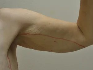 Body Contouring after Massive Weight Loss