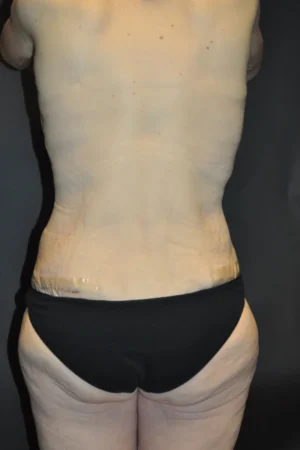 Body Contouring after Massive Weight Loss