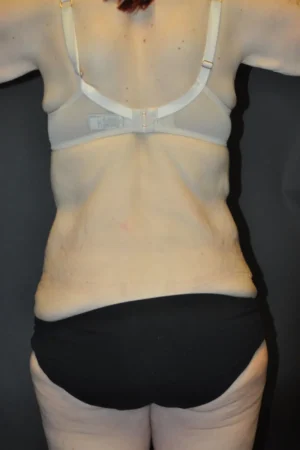 Body Contouring after Massive Weight Loss