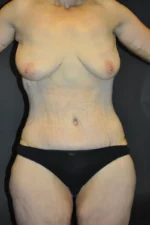 Body Contouring after Massive Weight Loss