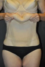 Body Contouring after Massive Weight Loss