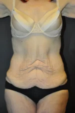 Body Contouring after Massive Weight Loss