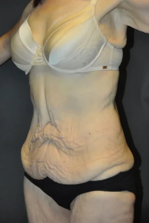 Body Contouring after Massive Weight Loss