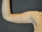 Brachioplasty