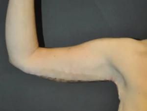 Brachioplasty
