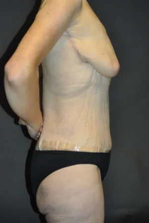 Body Contouring after Massive Weight Loss