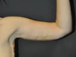Brachioplasty
