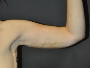 Brachioplasty