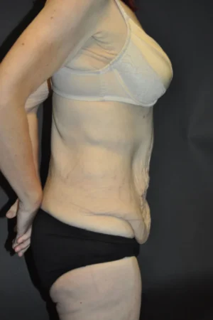 Body Contouring after Massive Weight Loss